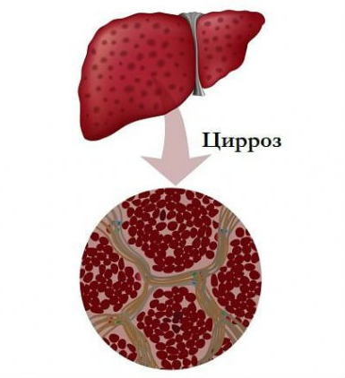 Цирроз печени: стадии, симптомы и лечение в Москве в ФНКЦ ФМБА России