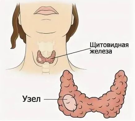 Кистозные образования и узлы щитовидной железы