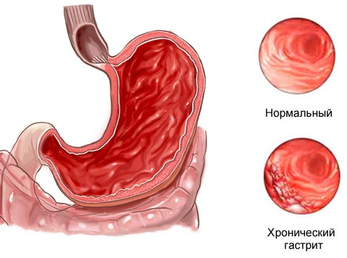 Лечение гастрита: медикаментозное, народными средствами, диетой