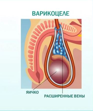 Последствия операции по поводу варикоцеле