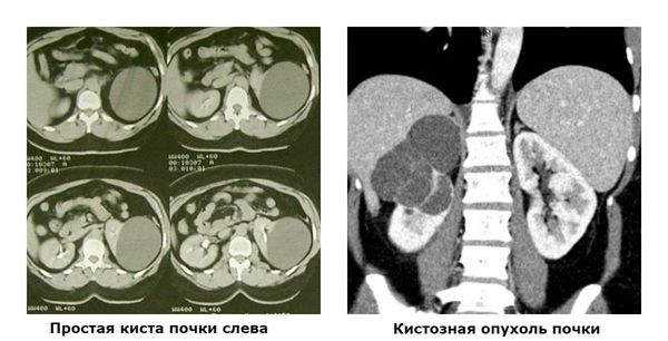 Как выглядит киста почки фото