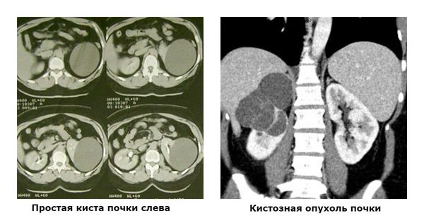 Картинка 2 - простая киста на МРТ и киста-опухоль на СКТ.jpg