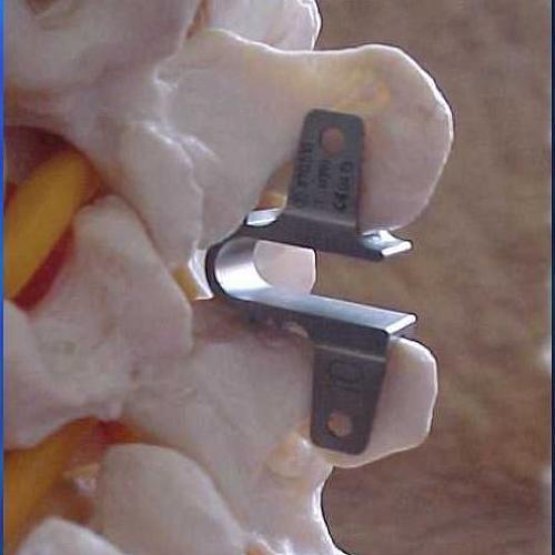 Имплант межпозвонкового диска поясничного отдела с фиксацией фото