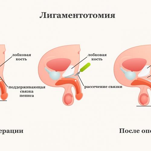 4 метода коррекции размеров пениса - Медицинский центр 