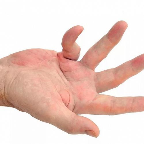 Боли в пальцах рук: причины, суставная боль, боль пальцев левой руки